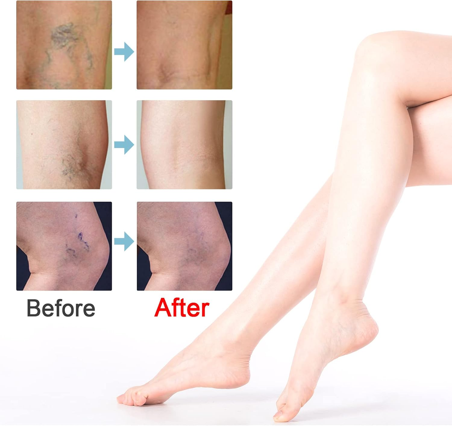 Veiniva™ | Vein relief cream