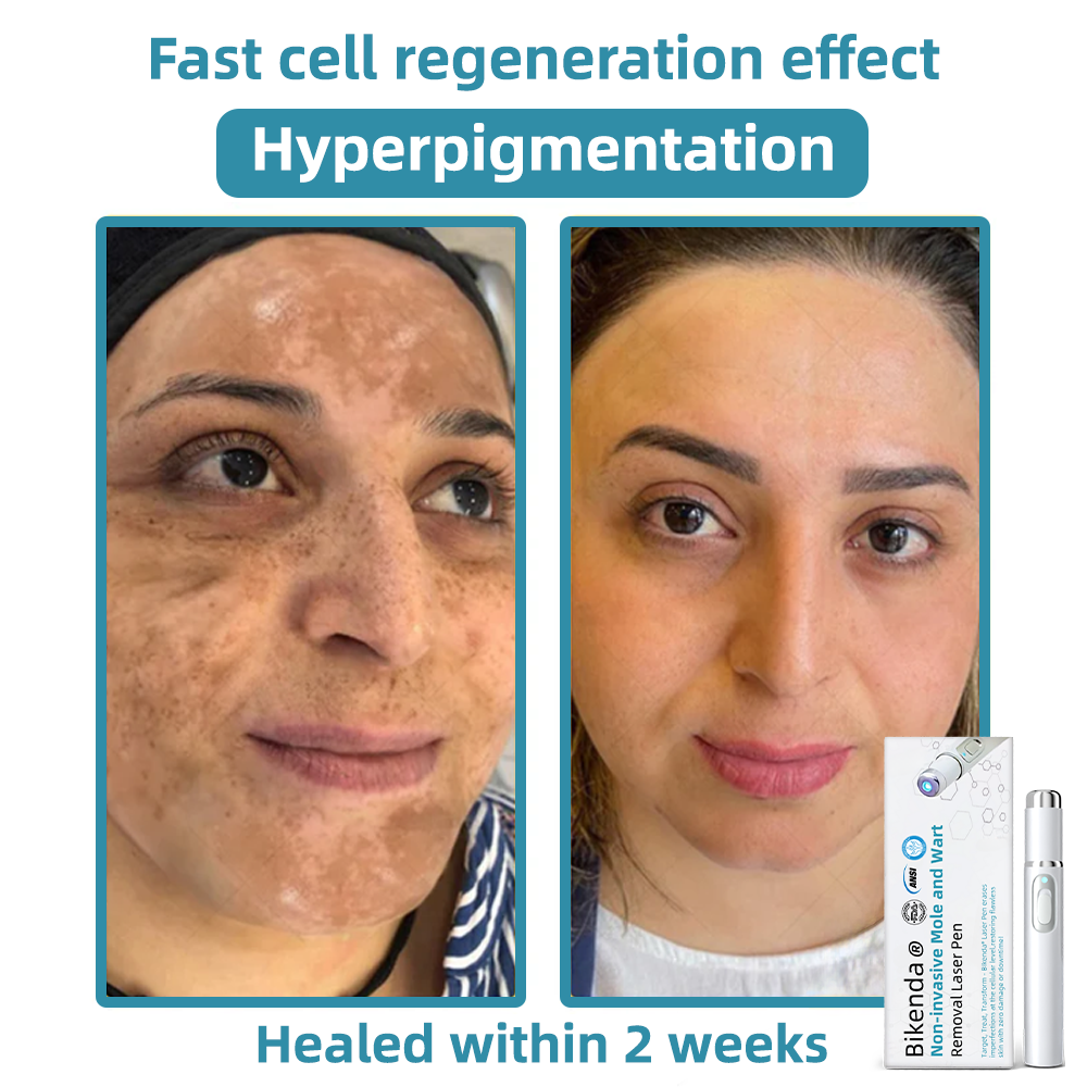 Dermiq™ | Mole and Wart Removal Laser Pen Promax