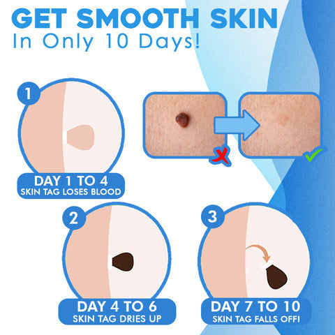 50% OFF | FlawFix™  | stalk wart removal kit