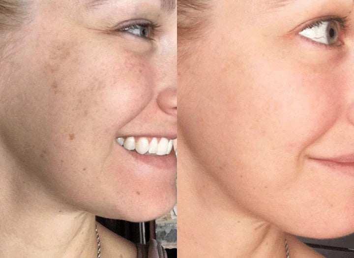 Buy 1 Get 1 Free | RadianceRoot™ | Dark Spot Correction, Say Goodbye to Dark Spots and Hello to Flawless Skin!